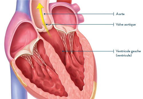 Sténose aortique et insuffisance aortique